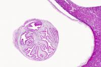 Coupe de muscle ladre (cystic